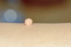 Anal-Warts-&-Skin-Tags-Orange-County-Hemorrhoid-Clinic