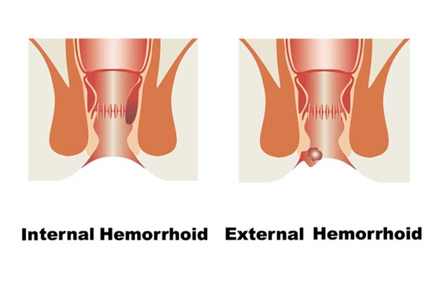 Hemorrhoid-Diagram