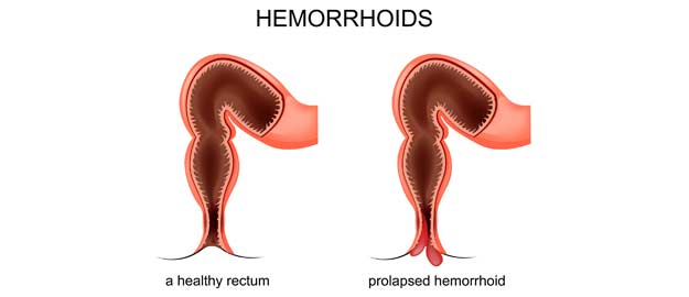 Hemorrhoid Doctor in Orange County-Orange County Hemorrhoid Clinic