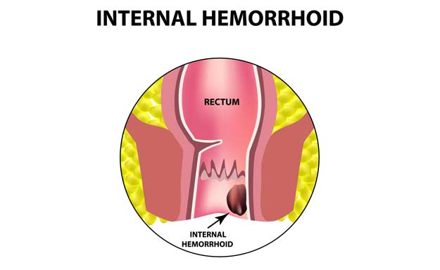 Hemorrhoid Specialist in Orange County-Orange County Hemorrhoid Clinic