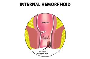 Hemorrhoid Specialist in Orange County