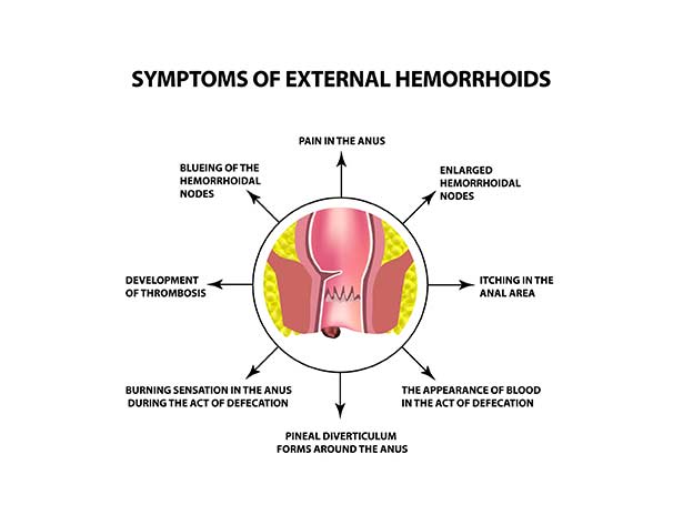 Hemorrhoid Treatment Center in Orange County-Orange County Hemorrhoid Clinic