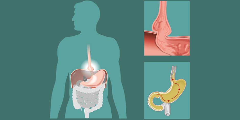 illustration-2-of-hiatal-hernia-OC-Hemorrhoid-Clinic