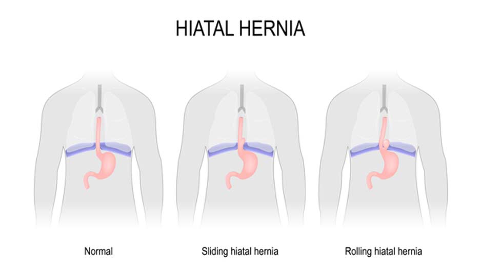 illustration-of-hiatal-hernia-OC-Hemorrhoid-Clinic