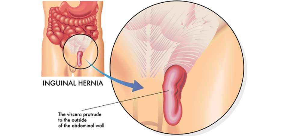 illustration-of-inguinal-hernia-OC-Hemorrhoid-Clinic