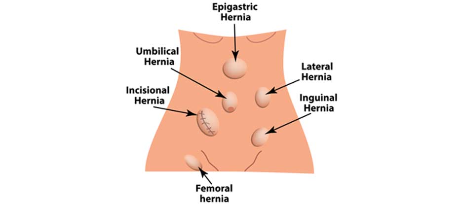location-of-inguinal-hernia-OC-Hemorrhoid-Clinic