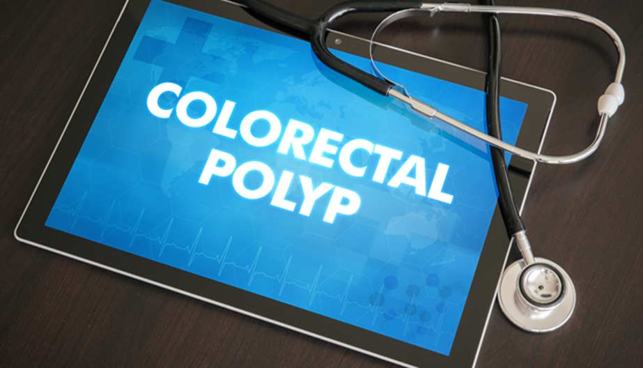 polyps-OC-Hemorrhoid-Clinic