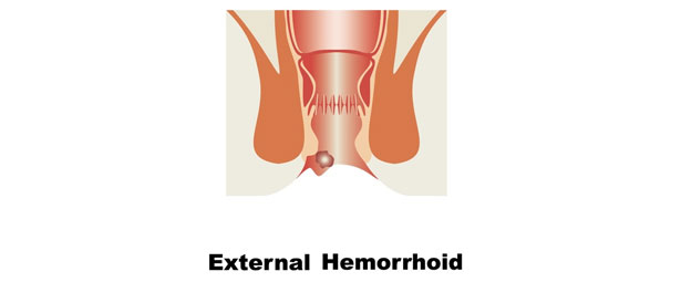 External-Hemorrhoids-Diagram