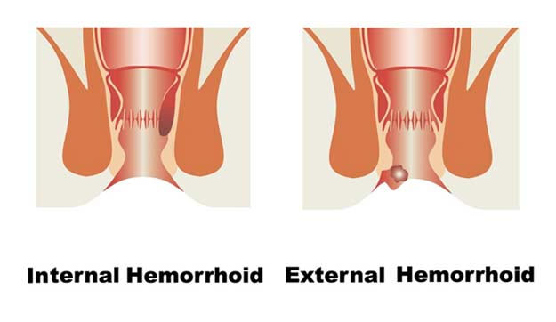 Hemorrhoid-Diagram