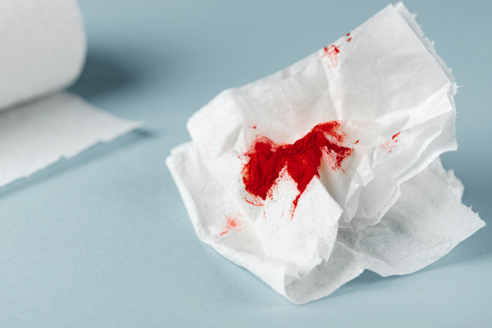 Is Bleeding Normal With External Hemorrhoids