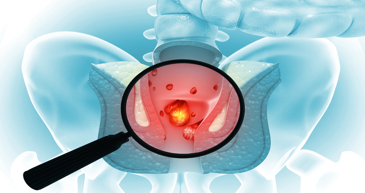 magnifying glass showing hemorrhoids on scientific background