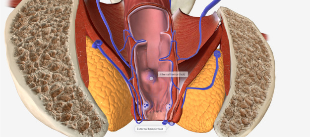 rendering of internal and external hemorrhoids