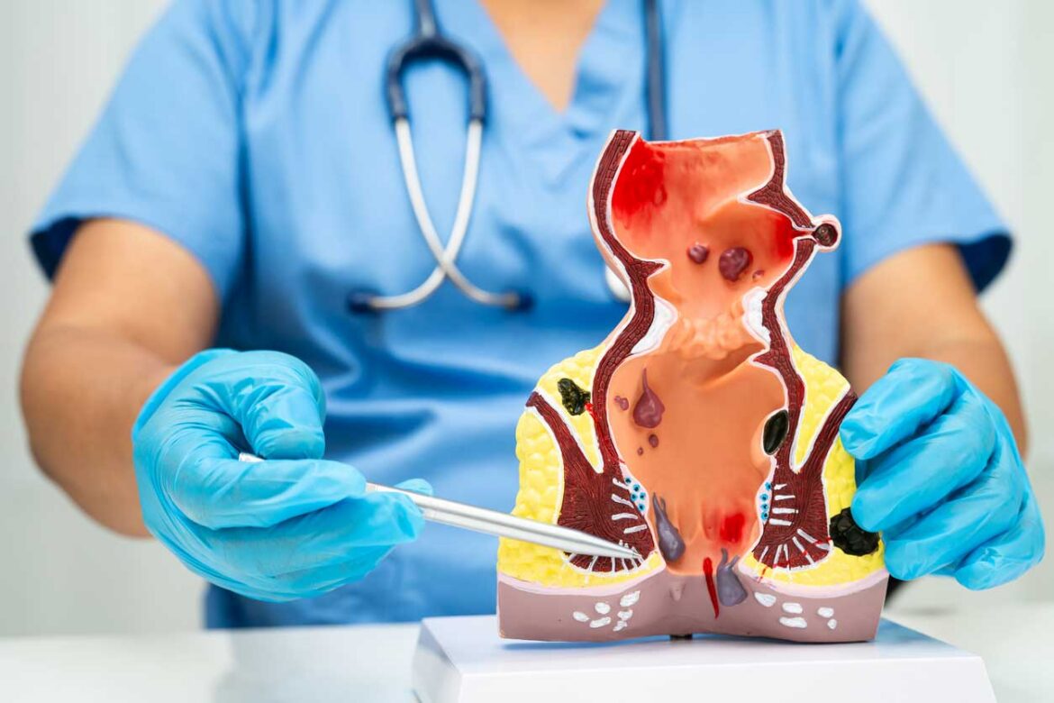 hemorrhoid-surgery